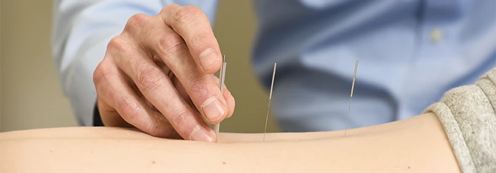 Chiropractor Canton OH Michael James Administering Acupuncture